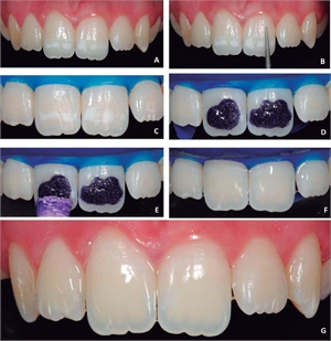 Dental technique of tooth enamel microabrasion