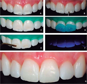 Enamel microabrasion with dental bur and composite veneering