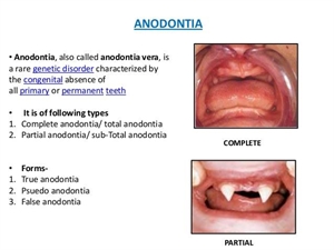 What is Anodontia