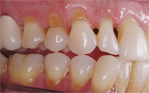 Dental abfraction is categorized as a non carious cervical tooth lesion 