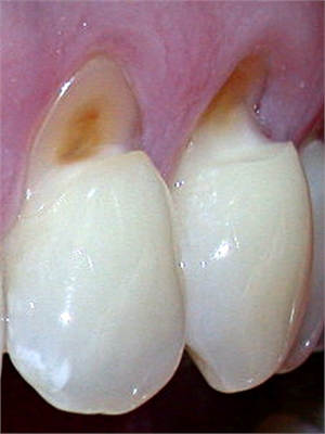 Tooth abfraction appears as enamel wear  at the cemento-enamel junction (CEJ)