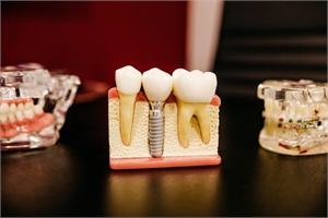 5 Questions to Ask Your Dentist Before Getting Titanium Dental Implants