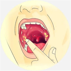 What is Tonsil caseum?
