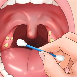 Removal of tonsil stones, also known as tonsil caseum, with a cotton bud at home