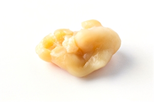 Giant tonsil stone extracted from the tonsil crypt - tonsil caseum or tonsillolith