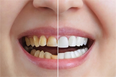 Cosmetic Dentistry: Top Procedures for Enhancing Your Smile and Well-Being