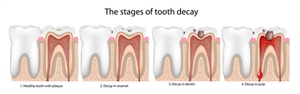 The 5 Stages of Tooth Decay