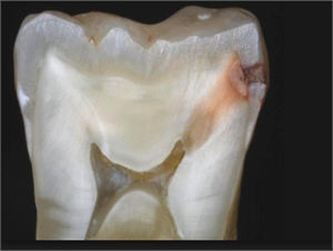 When the tooth cavity reaches the pulp, the last becomes infected. This is the stage of pulpal decay.