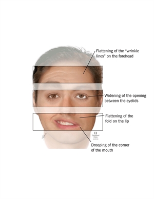 Symptoms of Bell's Palsy on patient