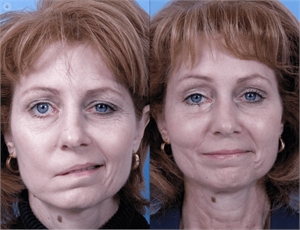 Facial paralysis - Bell's Palsy - before and after photo