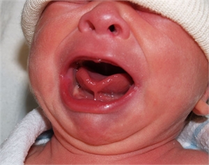 Ankyloglossia is he medical term for tongue tie.