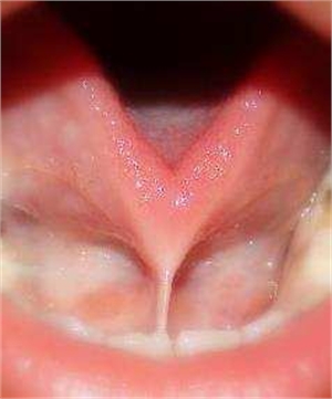 Tongue tie is also known as anchored tongue