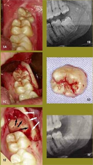 Coronectomy - surgical decoronation of impacted teeth
