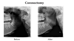 Coronectomy on wisdom teeth. Procedure is also known as tooth decoronation.