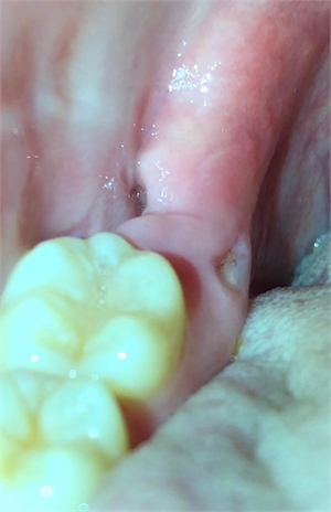 Bone spur spicule inside the gums