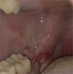Bone spur - small piece of tooth left over after tooth extraction