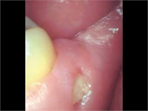 Bony spicule in the oral gingivae
