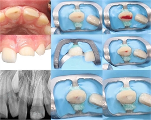 Partial pulpotomy (removing part of the dental pulp) after tooth fracture