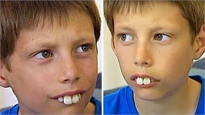 Patient with increased overjet, also known as buck teeth