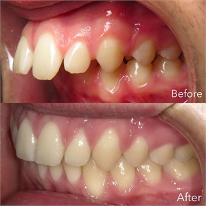 Buck teeth can be treated by an orthodontist and the bite can be restored to a normal occlusion (buck teeth or overjet correction)