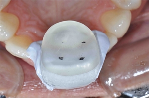 Lucia Jig occlusal view