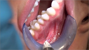 Intraseptal dental injection is used as a supplementary anaestetic technique to boost up the effect of numbing