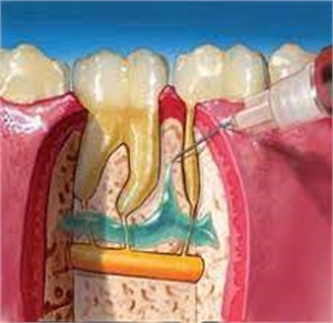 Intraseptal tooth injection is performed by administering the anaestetic inside the bony septum which seperates two adjacent teeth