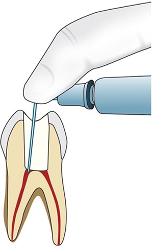Intrapulpal anaesthesia is injecting the numbing agent directly into the tooth nerve
