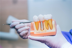 Tooth implant explained with a plastic dental model