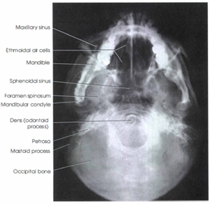 Submentovertex X-ray