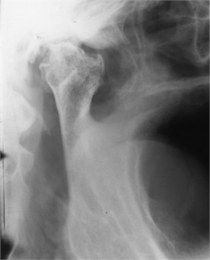 Transpharyngeal TMJ X-ray