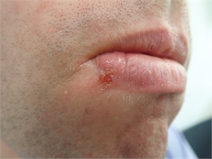Herpes labialis simplex is a recurrent infection of the edge of the lip caused by herpes simplex virus HSV