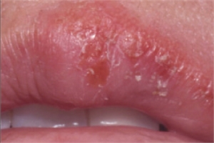 Herpes simplex labialis is also known as oral herpes