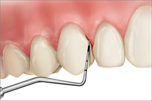 BOP or bleeding on probing is a measurement taken by dentists and periodontists to determine the gingival health