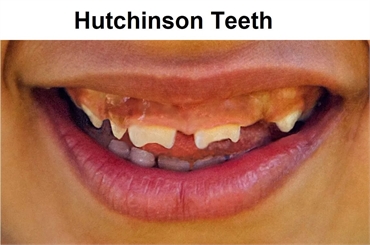 What are Hutchinson Teeth?