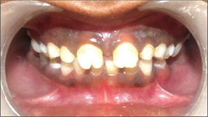 Hutchinson teeth are caused by congenital syphilis and attacks the permanent teeth