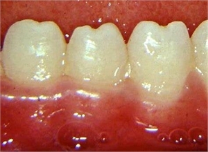 Hutchinson teeth are sign of congenital syphilis
