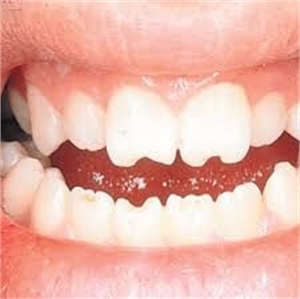 Patient with Hutchinson teeth - triangular or peg-like appearance of teeth