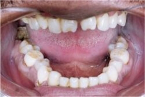 Dentition with Hutchinson teeth - sign of congenital syphilis