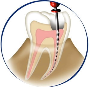 What is dental glide path?