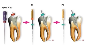 Dental glide path is the first stage of root canal mechanical instrumentation