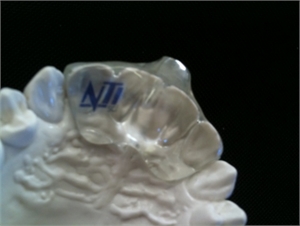 SCI Plus Splint is used to treat bruxism and relieve TMD symptoms.