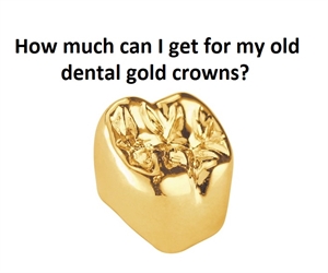 Can I get cash for my gold dental crowns?
