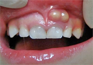 Dental fistula in the mouth