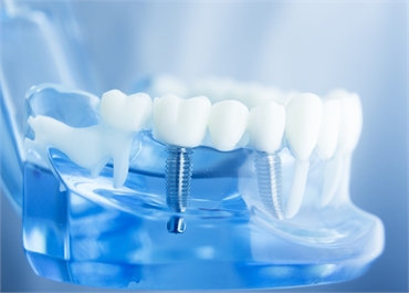A Guide to the Dental Implant Process