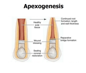 Apexogenesis promotes the apex closure and is carried out when the dental pulp is still vital or minimally inflamed.