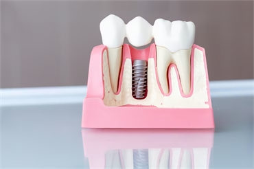 How to Maintain and Care for Your Dental Implants