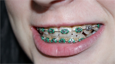 5 Tips to Take Care of Your Teeth When You Have Braces