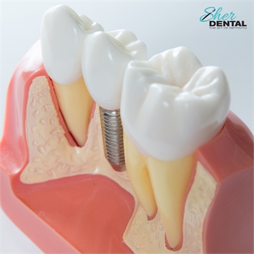 How to Get a Perfect Smile with Dental Implants