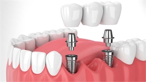 Understand The Reasons To Consider Dental Implants In Miami FL